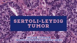 Sertoli-Leydig Tumor and DICER1-syndrome