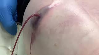 Брызгающий фонтаном гигантский прыщ. Big pimple!!! Cyst!!