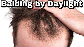 Balding by Daylight