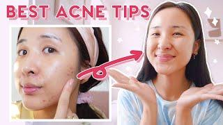 How to Use AHA, BHA & Niacinamide for ACNE & HYPERPIGMENTATION! (2021)