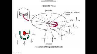 R wave progression from V1 - V6