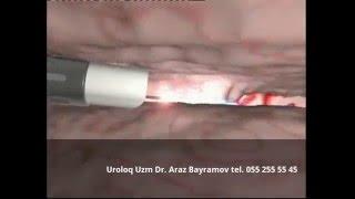 Prostat Adenoması - Holmium Lazerlə Müalicəsi-Uroloq Androloq Dr. Araz Bayramov