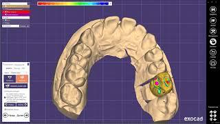 EXOCAD моделировка жевательных зубов