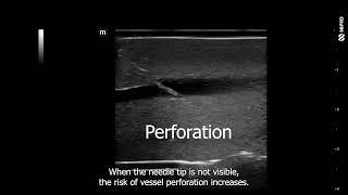 iMEP Tips & Tricks 26: Fundamental ultrasound principle