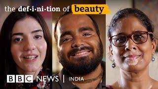 ‘I was told I looked like a Dalmatian dog’ | The Definition of Beauty | BBC News India