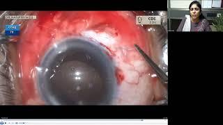 Lecture: My Best Cataract Case in the Past Two Years: Lessons Learned that Changed My Practice