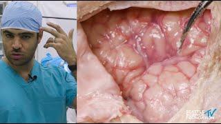 Orbitozygomatic Approach - Demonstration and Key Anatomy - Matias Costa, M.D.