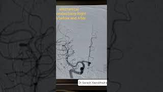 BRAIN STROKE IN GOLDEN HOUR - Mechanical ThrombectomyI BEFORE AFTER lOriginal DSA angiogram clip