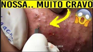 REMOVENDO CRAVO  E ESPINHAS GIGANTES! ESPREMENDO CRAVOS E ESPINHAS - CRAVOS E ESPINHAS 3
