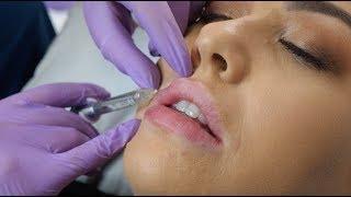 Lip Fillers - what to expect during the procedure | The Laser & Skin Clinic