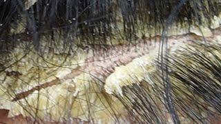 Dandruff scratching removal on head using black combing#152