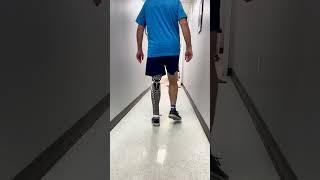 Scott Receives His New Prosthetic Leg at Our Denver Office - By Quorum Prosthetics
