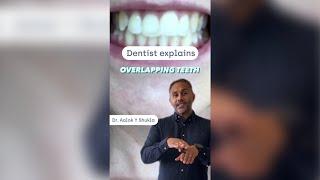 How to straighten overlapping teeth  #shorts