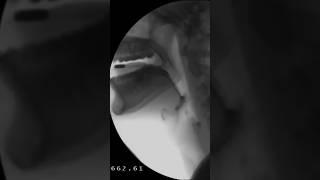 ️ Swallow X-Ray 13 mm Pill #dysphagia #slp #viralvideo #shortvideo #youtubeshorts #viral #shorts