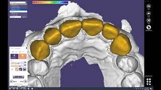 12 units: Design crowns/copings with Exocad