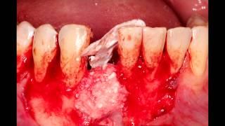 Guided Bone Regeneration by Dr. Oleg Ponomarev