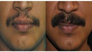 #Moustache#tretment#permanent#rksalon