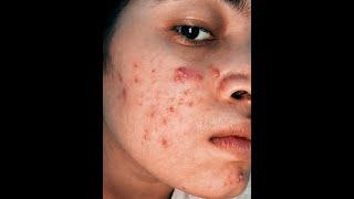 My Acne Journey Worst to Better skin #acnestory #acnejourney