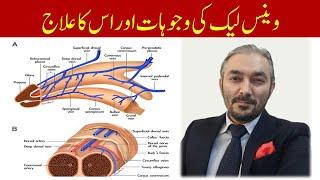 venous leak causes and treatment | venous leak ka ilaj in Urdu/Hindi | Dr Fartash Sarwar