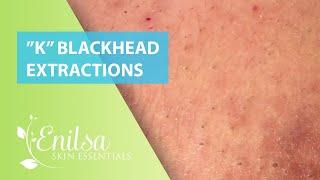 Blackheads Extractions “K’s” 4th Treatment