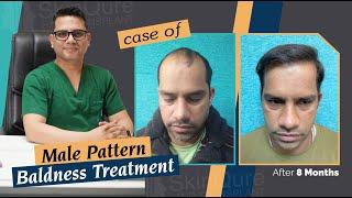 Male Pattern Baldness Treatment | Best Hair Transplant - Dr. Jangid |  Delhi | Patient's Case Study