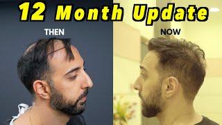 12 Month 2nd Hair Transplant Update | 4000 GRAFTS FUE | SUCCESS OR FAILURE?