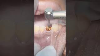 Fractured tooth build up with composite restoration #dentist