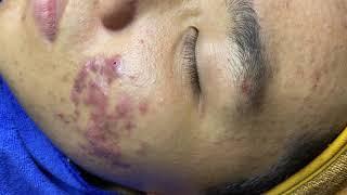 Acne Treatment For Hoang (P2) | Điều Trị Mụn Cho Bạn Hoàng (P2) - SacDepSpa#269