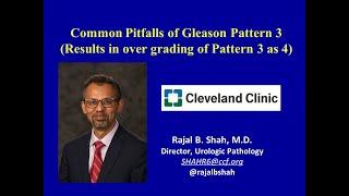 Common pitfalls that result in overgrading of prostate cancer Gleason pattern 3 as 4