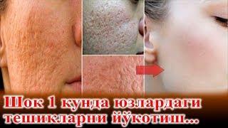 Юздаги Тешиклардан халос бўлинг силлиқ тиниқ терига эга бўлинг