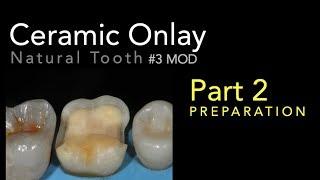 Lithium Disilicate Ceramics, Part  2: Ceramic Onlay Preparation