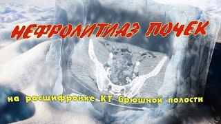 ГЕПАТОМЕГАЛИЯ печени, КАМНИ в почках и НЕФРОЛИТИАЗ на расшифровке КТ брюшной полости (второе мнение)