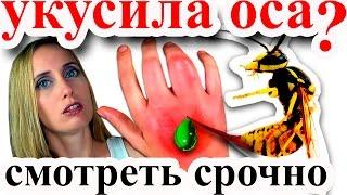 УКУС ОСЫ//ВАС УКУСИЛА ОСА?//СМОТРИТЕ ЧТО ДЕЛАТЬ ПРИ УКУСЕ ОСЫ!