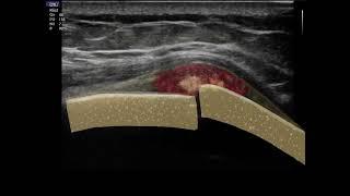 Fracture de côte / Rib Fracture ( Echographie  / Ultrasound Scan )