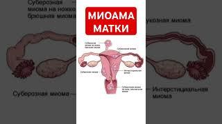 МИОМА МАТКИ#shortvideo #интересно