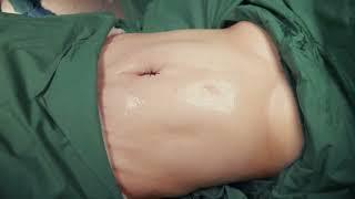 Dr.Vüsal Abdullayev - Plastik cərrah  Abdominoplastika Əməliyyatı