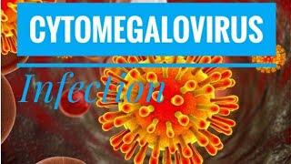 Cytomegalovirus (CMV) - transmission, pathogenesis, clinical presentation, diagnosis & treatment