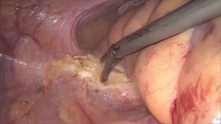 Laparoscopic clockwise three-stage radical total proctocolectomy