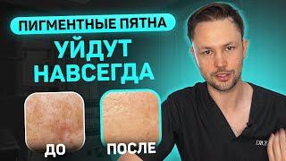 Пигментные пятна на лице. Как я лечу мезму у своих пациентов