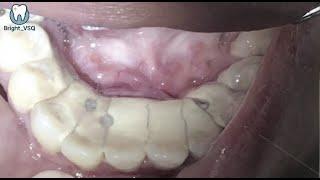 Can You Watch Till the End? Top 3 Most Shocking Tartar Removals!#120