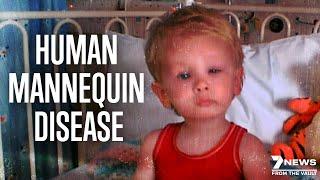 World's Rarest Disease: The Human Mannequin | Documentary