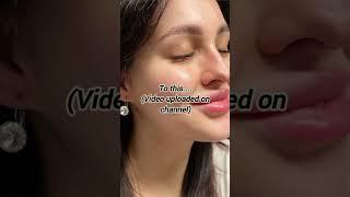 No more acne & oily skin!!