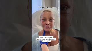 Facelift Before & After #faceliftnyc #faceliftnj #plasticsurgery #viral #transformation #facelift