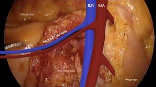 Modified Complete Mesocolic Excision With Central Vascular Ligation