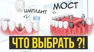 Зубной МОСТ или ИМПЛАНТАЦИЯ зубов — что выбрать? Плюсы минусы!