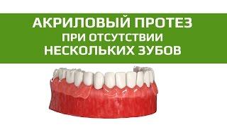 Съемные зубные протезы: частичный акриловый протез