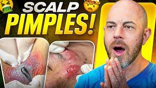 Doctor Reacts to Skin Tag Removals, Pimple Pops, and Extractions