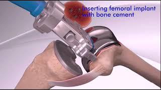 Total Knee Replacement TKR   Animation