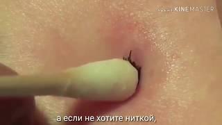 Как вытащить клеща. How to pull a mite. Cómo tirar de un ácaro