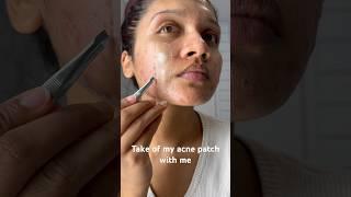 Pimple patch. #acne #acnepatch #pimplepatch #cystic #cystpoping #cyst #acnetreatment #pimples